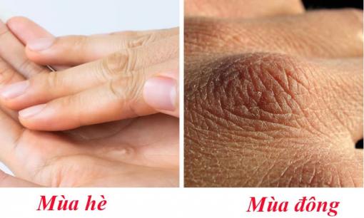 6 vấn đề sức khỏe xảy ra với cơ thể vào mùa đông, đôi khi chúng ta không để ý đến 