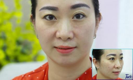 Bí quyết giúp tôi thoát khỏi 10 năm nám sau sinh