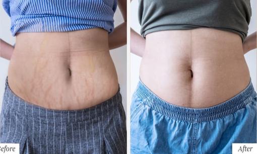 Bí quyết trị rạn lâu năm của chị em Bà Rịa - Vũng Tàu