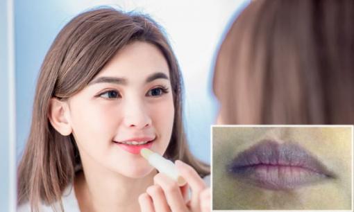 8 nguyên nhân khiến môi thâm đen không phải ai cũng biết để tránh
