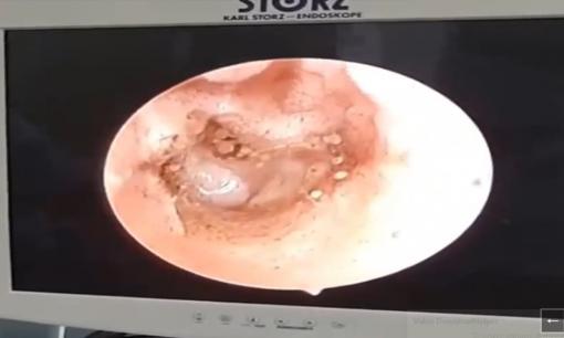 Tá hỏa cảnh hàng chục cây nấm mọc trong tai người đàn ông