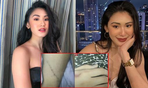 Cảnh sát công bố hình ảnh bầm tím khắp cơ thể của Á hậu Philippines nghi bị hiếp dâm tập thể đến chết