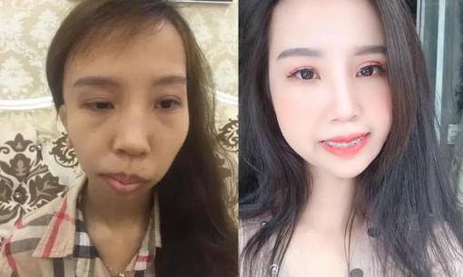 Màn 'lột xác' ngoạn mục của cô gái bị teo nửa bên mặt