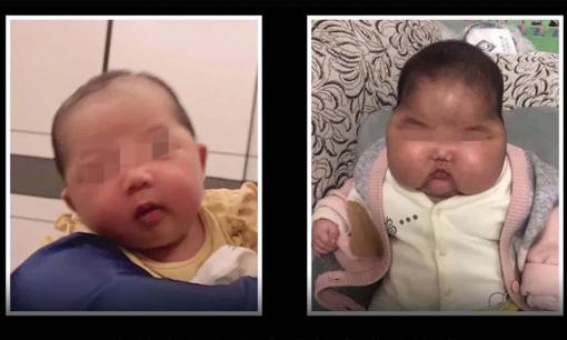 Thấy mặt con phình to bất thường, bố mẹ đưa đi khám và phát hiện ra sự thật không ngờ