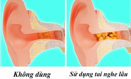 Đây là những điều sẽ xảy ra với cơ thể nếu bạn đeo tai nghe quá lâu