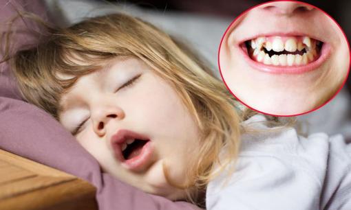 Trẻ thường há miệng khi ngủ, đây là điều bé có thể phải đối mặt trong tương lai