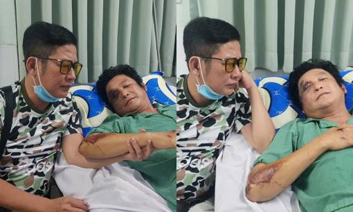 Tấn Beo bất ngờ chia sẻ hình ảnh xót xa của nghệ sĩ Trọng Phúc bị tai nạn, chấn thương mặt và vai