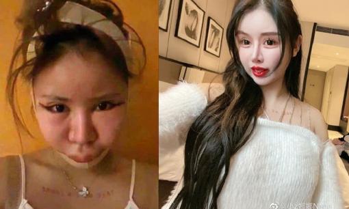 Diện mạo của cô gái chi 14 tỷ đồng để sửa mặt nhiều lần trong suốt ba năm