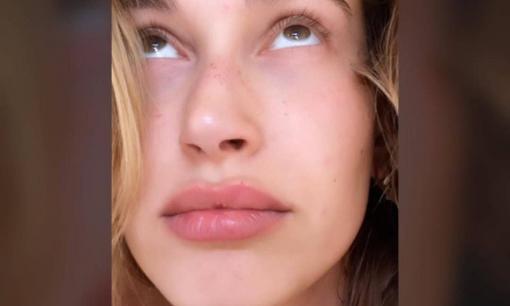 Chỉ vì một bức ảnh chụp cận mặt mà vợ Justin Bieber bị dân mạng xâu xé 