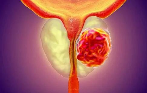 Sau khi đàn ông ngoài 40 tuổi, trong cơ thể xuất hiện 7 dấu hiệu này, ung thư tuyến tiền liệt có thể sẽ tìm đến