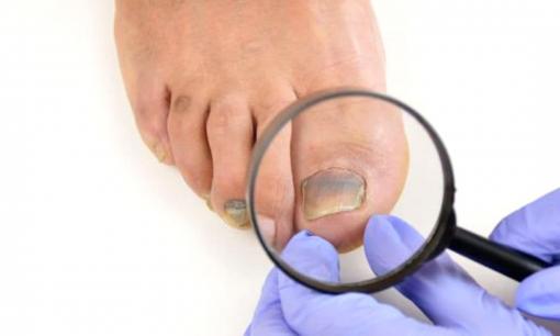 Phát hiện bệnh qua màu sắc móng chân