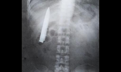 Người đàn ông bị một con dao găm vào ngực suốt 14 tháng mà không hề biết