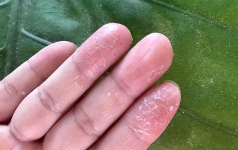 Thường xuyên bị bong tróc da tay, chân có phải thiếu vitamin không? Có thể là những lý do này 