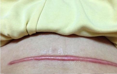 3 di chứng không thể thoát khỏi khi sinh mổ, càng rõ sau khi sinh con thứ 2. Các mẹ bầu cần lưu ý