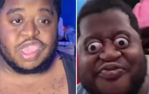 Xương của nam diễn viên hài người Mỹ có thể ép mắt ra khỏi hốc mắt