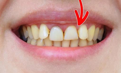 7 thói quen hàng ngày khiến răng bạn bị ố vàng