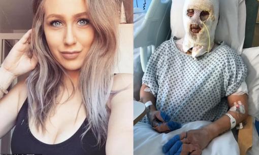 Cô gái xinh đẹp bị đốt cháy cả gương mặt khi người bạn uống say đổ rượu vào bếp cồn 'cho vui'