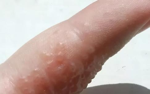 Ngứa ngáy! Những 'mụn nước nhỏ' mọc vào mùa hè? Chỉ bạn biết làm thế nào để điều trị nó 