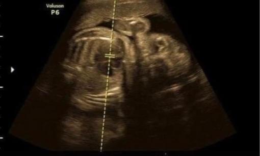 Vợ bầu 7 tháng nhờ chồng bê chậu quần áo không được nên tự làm cuối cùng bị ngã, con không có tim thai