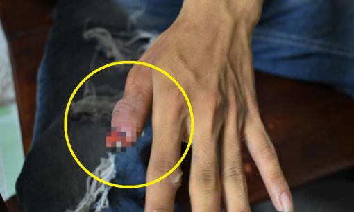 Dùng tay nạy răng chó Pitbull nhà hàng xóm để cứu con, người cha bị cắn cụt đốt ngón tay, nhớ lại vẫn bàng hoàng