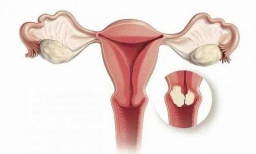 Chảy máu sau khi 'quan hệ', đây có phải là dấu hiệu của bệnh ung thư cổ tử cung? 