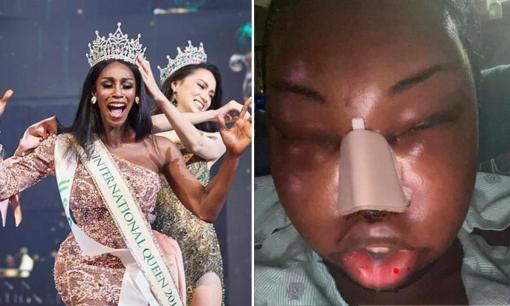 Hoa hậu Chuyển giới Quốc tế kế nhiệm Hương Giang đăng ảnh biến dạng sau khi 'đập mặt xây lại'