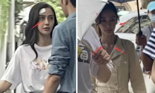 Angelababy gây choáng với hình ảnh mắt thâm quầng, gầy như 'bộ xương di động'