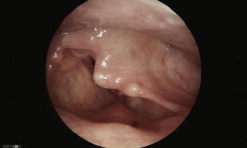 Khàn tiếng lâu ngày là tín hiệu của bệnh ung thư thanh quản, 4 triệu chứng này cần chú ý