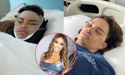 Cựu ‘bom sex’ Katie Price lại ‘trùng tu’ nhan sắc sau hàng loạt ca phẫu thuật thảm họa
