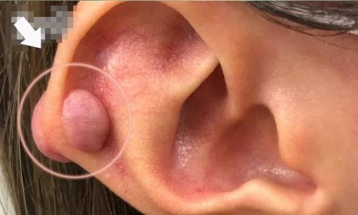 Khóc lóc thảm thiết vì sau khi xỏ lỗ tai thì 2 'hạt lạc' to tướng xuất hiện, xấu đến mức 'dựng cả tóc gáy'