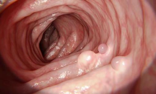 Muốn sống lâu thì trước hết hãy “sống ruột”! Nhắc nhở: Đối với sức khỏe đường ruột, hãy ăn ít hơn 3 thứ và làm ít hơn 3 thứ