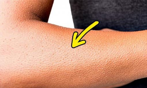 Liên tục nổi da gà - nguyên nhân gây ra và cách khắc phục