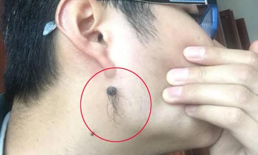 Tại sao trên nốt ruồi lại mọc lông và có nên nhổ lông trên nốt ruồi không?