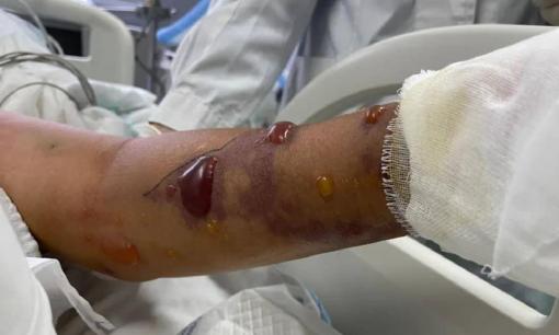 Ông lão ở Quảng Tây thoát chết thần kỳ sau khi rửa hải sản, hãy cảnh giác với loại vi khuẩn cực kỳ nguy hiểm này 