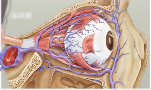 Bé trai 8 tuổi ngoáy mũi đưa vi khuẩn vào não, thói xấu dọa giết người, vùng tam giác mũi miệng không thể ngờ được