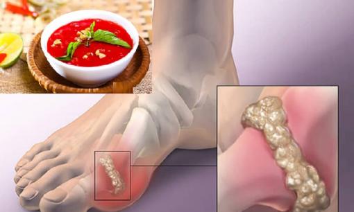 Người bệnh gút (gout) có ăn nội tạng động vật, tiết canh được không? Nhiều người đoán sai sự thật