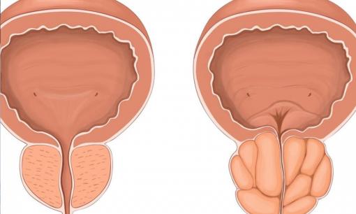 Một hành vi trong đời sống vợ chồng làm tổn thương tuyến tiền liệt của đàn ông, vì vậy đàn ông không còn vui vẻ trong chuyện ấy nữa 