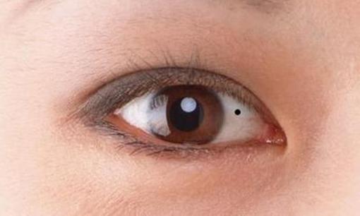 Người có nốt ruồi ở lòng trắng mắt thường tài vận kém và khó chung thủy
