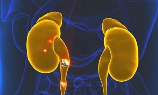 Người có thận tốt dễ bị 'nóng' 3 phần, nếu bạn nào cũng vậy thì xin chúc mừng, thận vẫn khỏe!