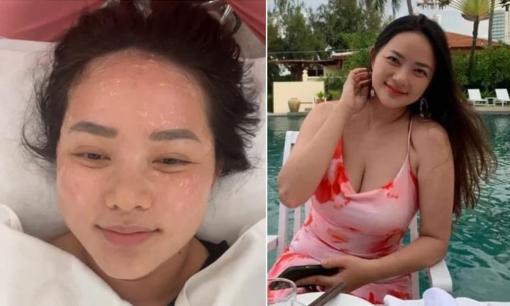 Phan Như Thảo chịu đau nâng cơ mặt sau khi để lộ 'râu rồng' vì giảm 10 kg