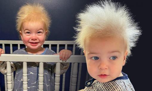 Cậu bé người Mỹ mắc hội chứng tóc khó chải hiếm gặp: Einstein cũng mắc chứng bệnh này và sinh ra với mái đầu 'bùng nổ'