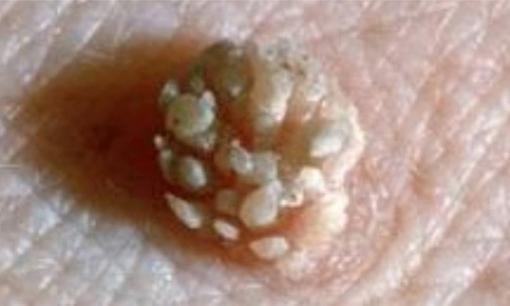 Một phụ nữ 28 tuổi bị phát hiện dương tính với HPV khiến chồng xa lánh!  Bác sĩ: Thực hiện 3 điều có thể chuyển thành âm tính 