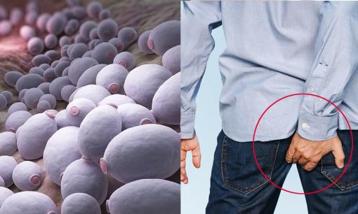 Vùng xung quanh hậu môn thường xuyên ẩm ướt và ngứa ngáy, phải làm sao để khắc phục nhanh chóng? 4 gợi ý bạn nên chú ý