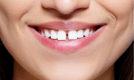 Phụ nữ có tướng răng này, nhìn là biết số giàu sang hay nghèo hèn: Răng cửa có khe hở là tài vận không vượng