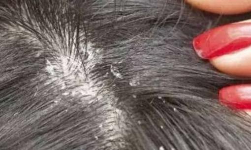 Đầu nhiều gàu chỉ sau một ngày không gội? Nó có thể liên quan đến những thói quen sinh hoạt này, thay đổi càng nhanh càng tốt