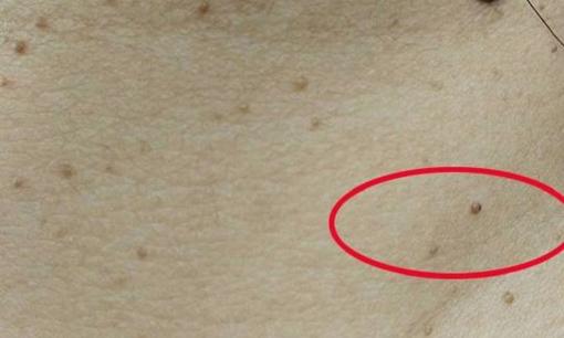 Các mụn thịt nhỏ mọc trên cổ liên quan đến 4 nguyên nhân, có thể bệnh đang đến gần