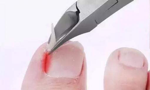 Móng chân luôn ăn sâu vào thịt, khi chạm vào vẫn thấy đau? Hướng dẫn bạn những thủ thuật nhỏ để giảm bớt tổn thương và tạm biệt nỗi đau 