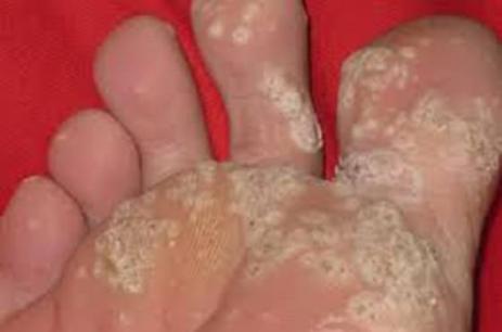 Ai nói bệnh nấm da chân không thể chữa khỏi? Những biện pháp nhỏ này hoạt động tuyệt vời! ! 