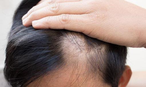 Một số người không rụng tóc cả đời, và một số người bị hói trước tuổi trung niên: Hóa ra sự khác biệt là ở những điều này