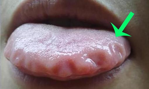 Mép lưỡi “răng cưa”, thực ra là “nặng quá”, dạy bạn “một mẹo” hút ẩm siêu nhanh đơn giản, nam nữ đều dùng được nhé!